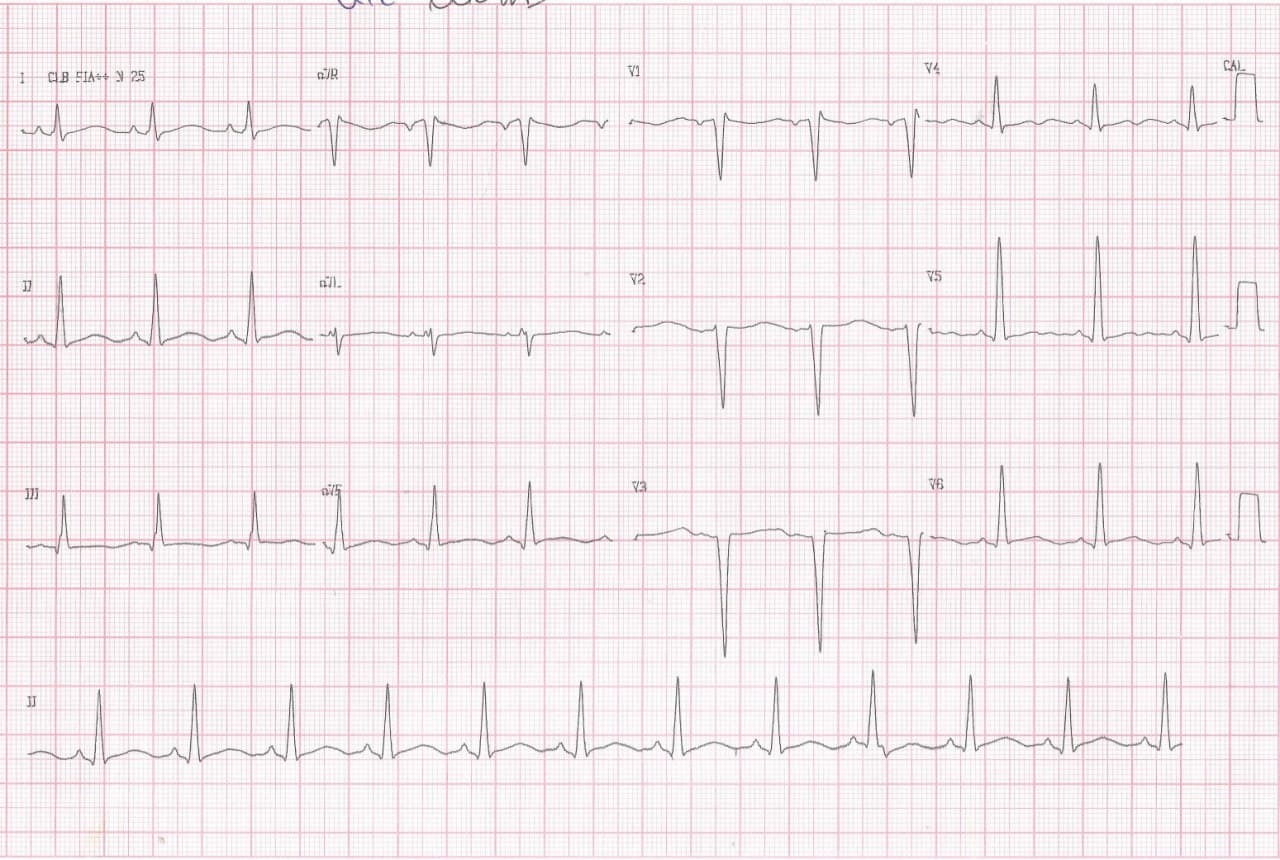 Paciente masculino de 67 años, HTA y DBT, con antecedente de infarto previo cursando infección respiratoria que es tratada con azitromicina  cuyo ECG presenta QTL adquirido