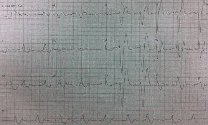 Hombre de 52 años portador de diabetes tipo II, HTA, insuficiencia cardíaca y EPOC con fatiga y letargo en quién se constata severa hiperpotasemia