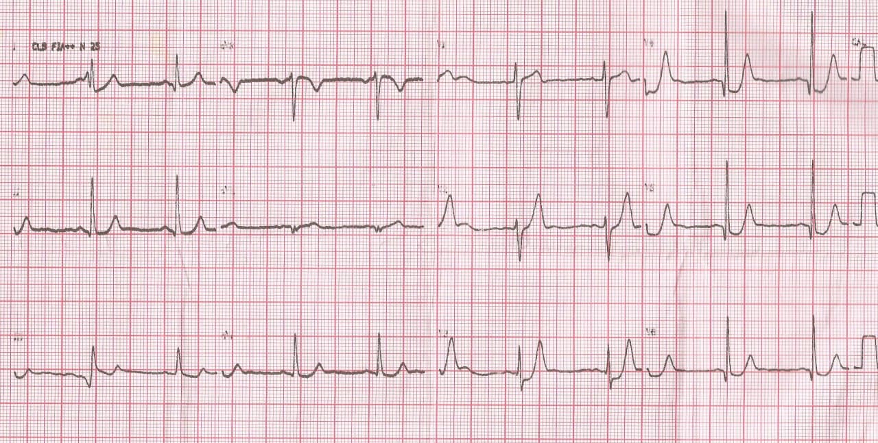 Paciente con episodio de ángor prolongado por SCA que presenta patrón de Winter por compromiso de la DA proximal