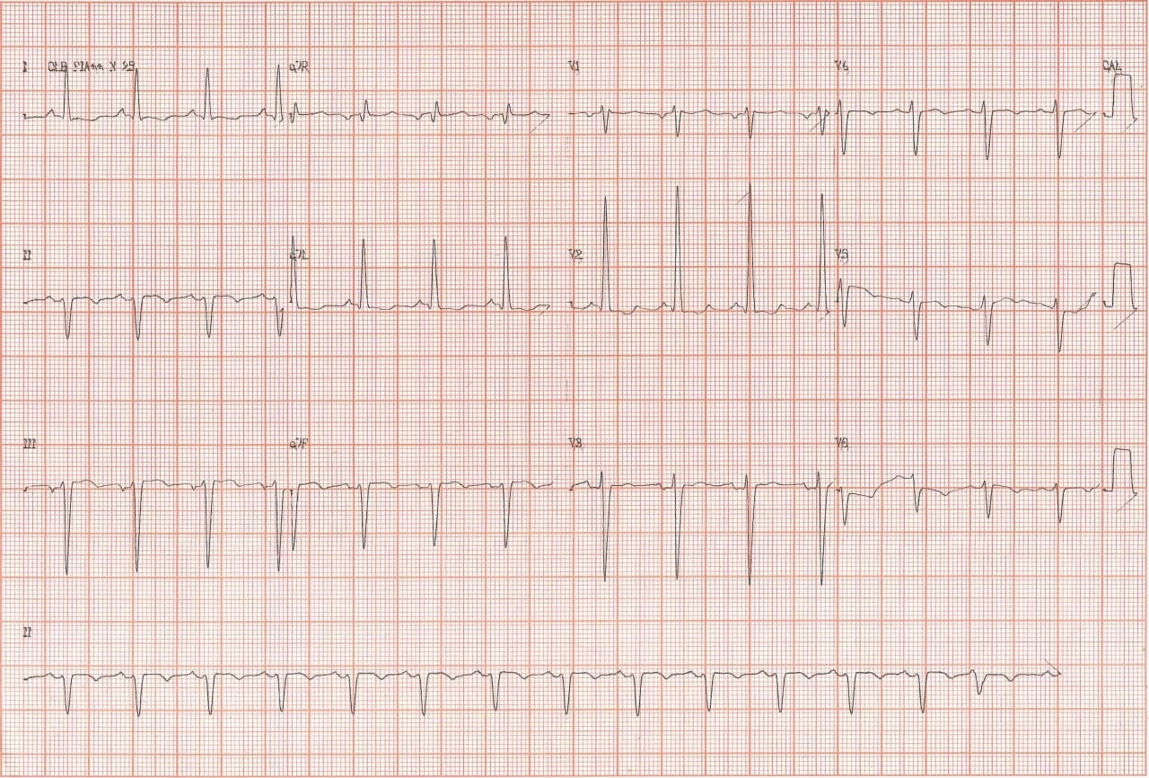 Mujer de 79 años con antecedente de SCA y colocación de stent a la DA que ingresa con EAP por estenosis del stent que se manifiesta por FAP y que requiere angioplastia con resultado exitoso