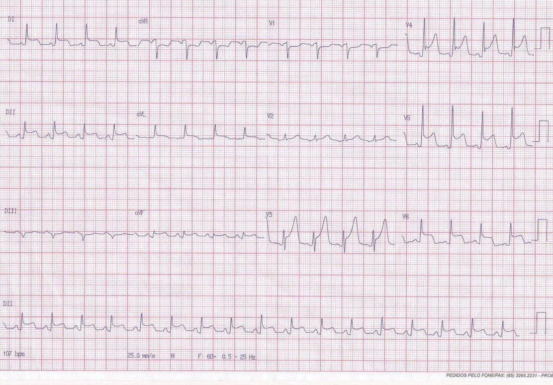 Mujer de 55 años con antecedente de mastectomía bilateral que presenta dolor toráccico con irradiación dorsal, que aumenta con la respiración profunda, tos seca y fiebre con signo de Spodick + por pericarditis constrictiva y miocardiopatía restrictiva