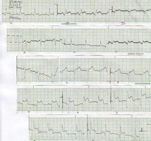 Paciente de 33 años portador de una miocardiopatía hipertrófica cuyo ECG simula infarto de miocardio