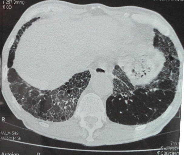Paciente de 64 años con cuadro de insuficiencia cardíaca y antecedentes de episodios de FA paroxística tratado crónicamente con amiodarona que presenta disnea atribuible a toxicidad pulmonar por la droga que mejora con corticoides