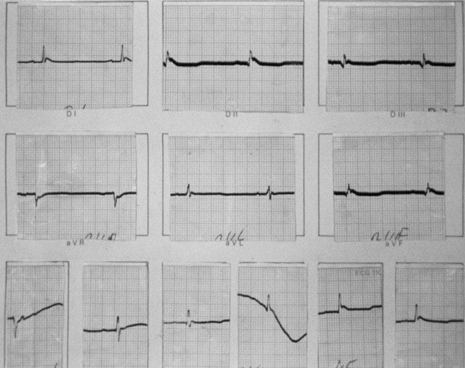 Hombre de 63 años en estado terminal de shock séptico hallado en coma, con franca hipotermia que presenta ondas de Osborn en el ECG