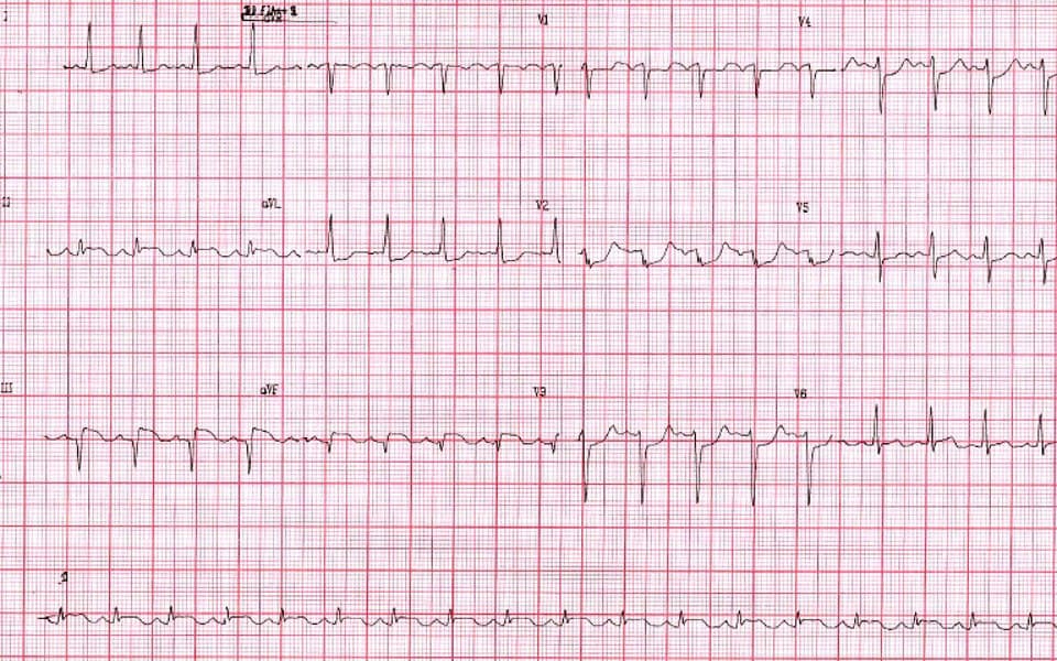Hombre de 48 años que presenta episodio de ángor muy severo vinculado a SCA por suboclusión de Cx