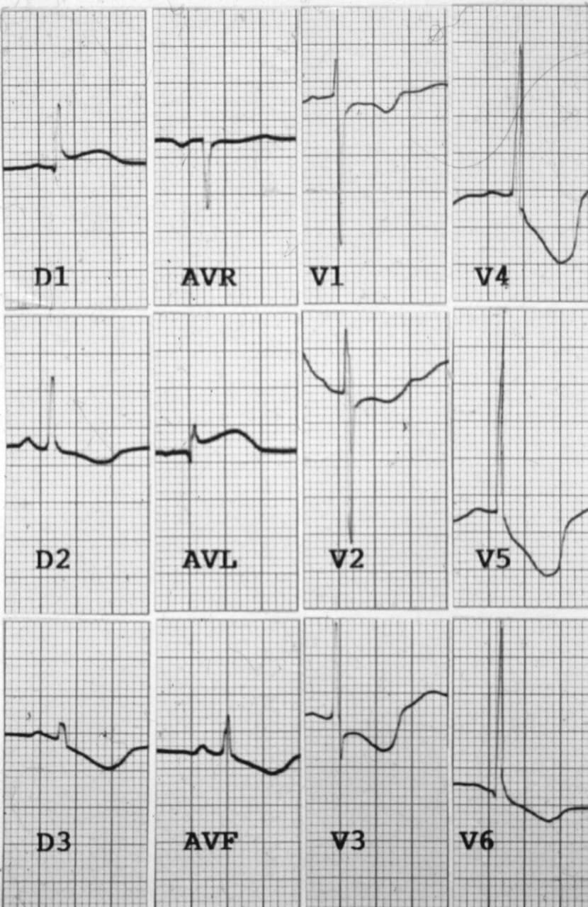 Niña de 7 años que presenta pérdida súbita de consciencia ingresando en coma Glasgow grado IV cuyo ECG presenta ondas T cerebrales, con presencia de hemorragia cerebelosa por meduloblastoma hemorrágico