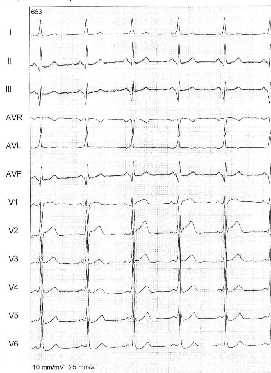 Hombre de 61 años, diabético que presenta palpitaciones recurrentes por presencia de vía accesoria y patrón ECG de «pseudo infarto inferior» sometido a ablación exitosa de la vía