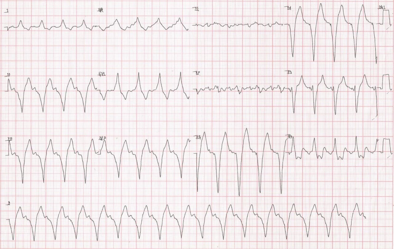 Paciente de 65 años, hipertenso y diabético con MP implantado previamente por BAVC que consulta por disnea que cursa con severa hiperpotasemia