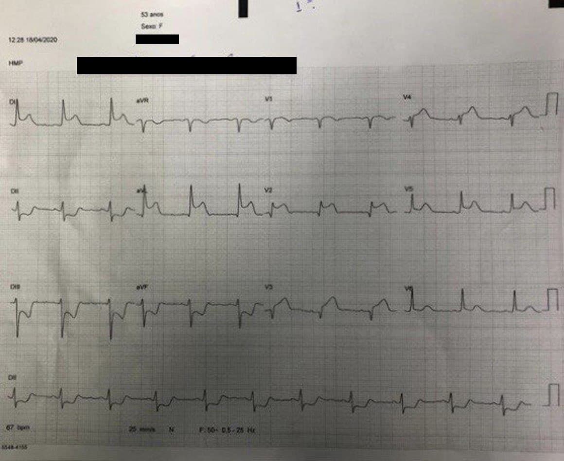 Mujer de 53 años que presenta episodio de ángor prolongado en la que se observa IAM ánterolateral en evolución, por compromiso de la DA proximal con trombo siendo sometida a angioplastia primaria