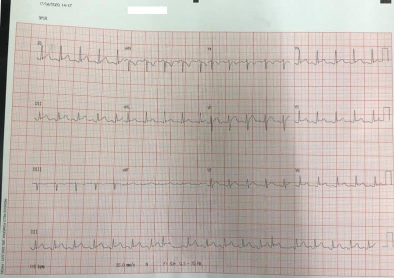 Paciente masculino de 30 años que cursa con cuadro febril de 6 días de evolución, dolor de tipo pericardítico, troponina elevada debido a miopericarditis en contexto de COVID 19 +