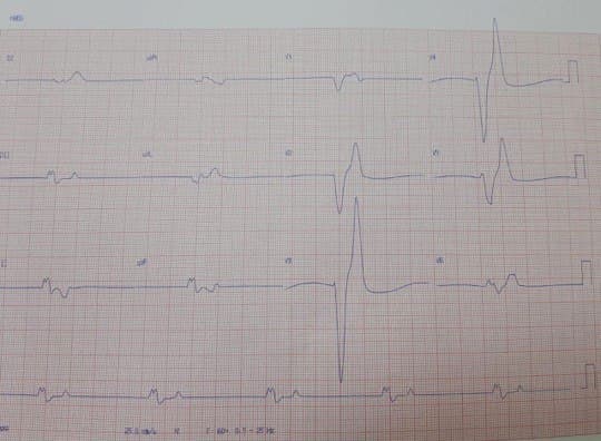 Paciente masculino polimedicado que cursa con diarrea y vómitos, con severa hiperkalemia de 8,1 mEq/l