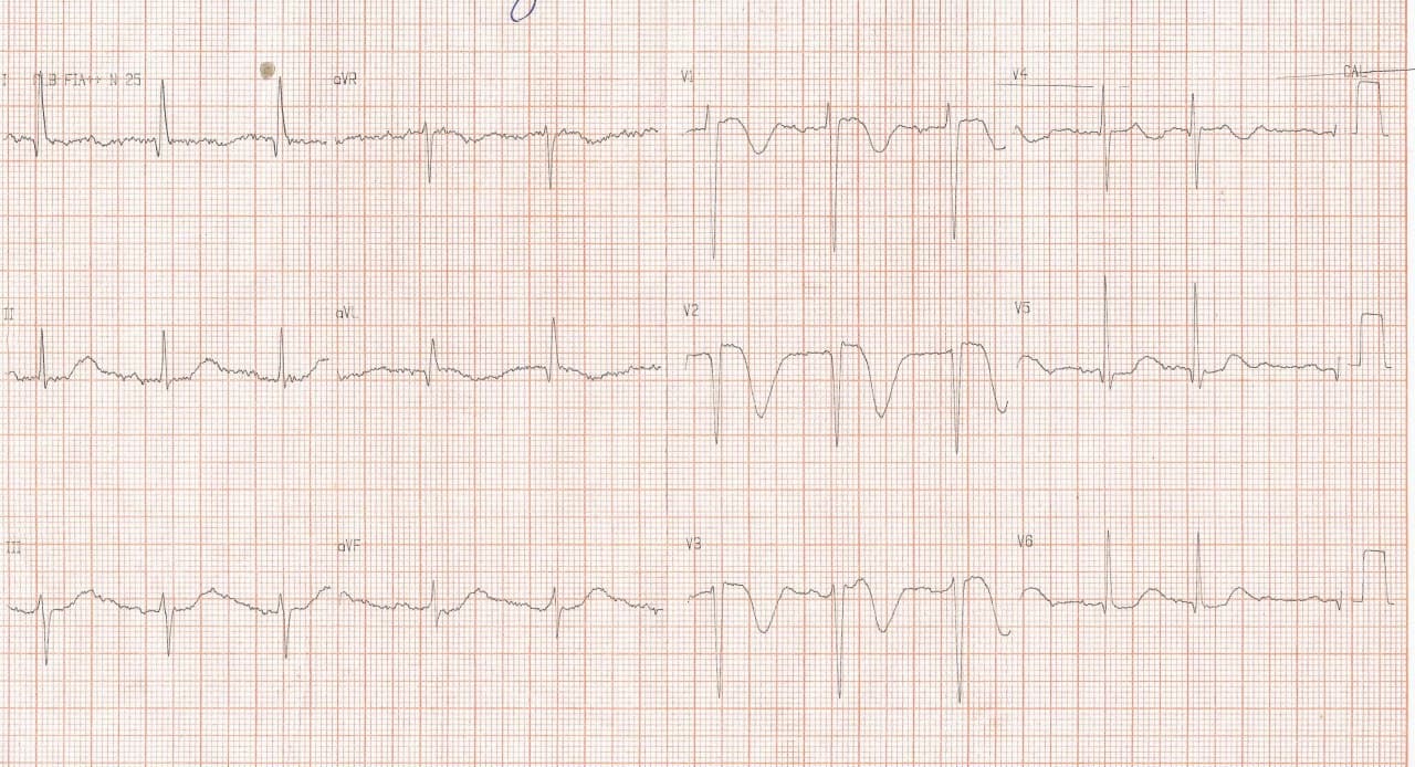Mujer de 84 años que consulta por intensa cefalea de varios días de evolución, acompañada de náuseas, vómitos y desequilibrio al caminar en quién se constata gran infarto cerebeloso