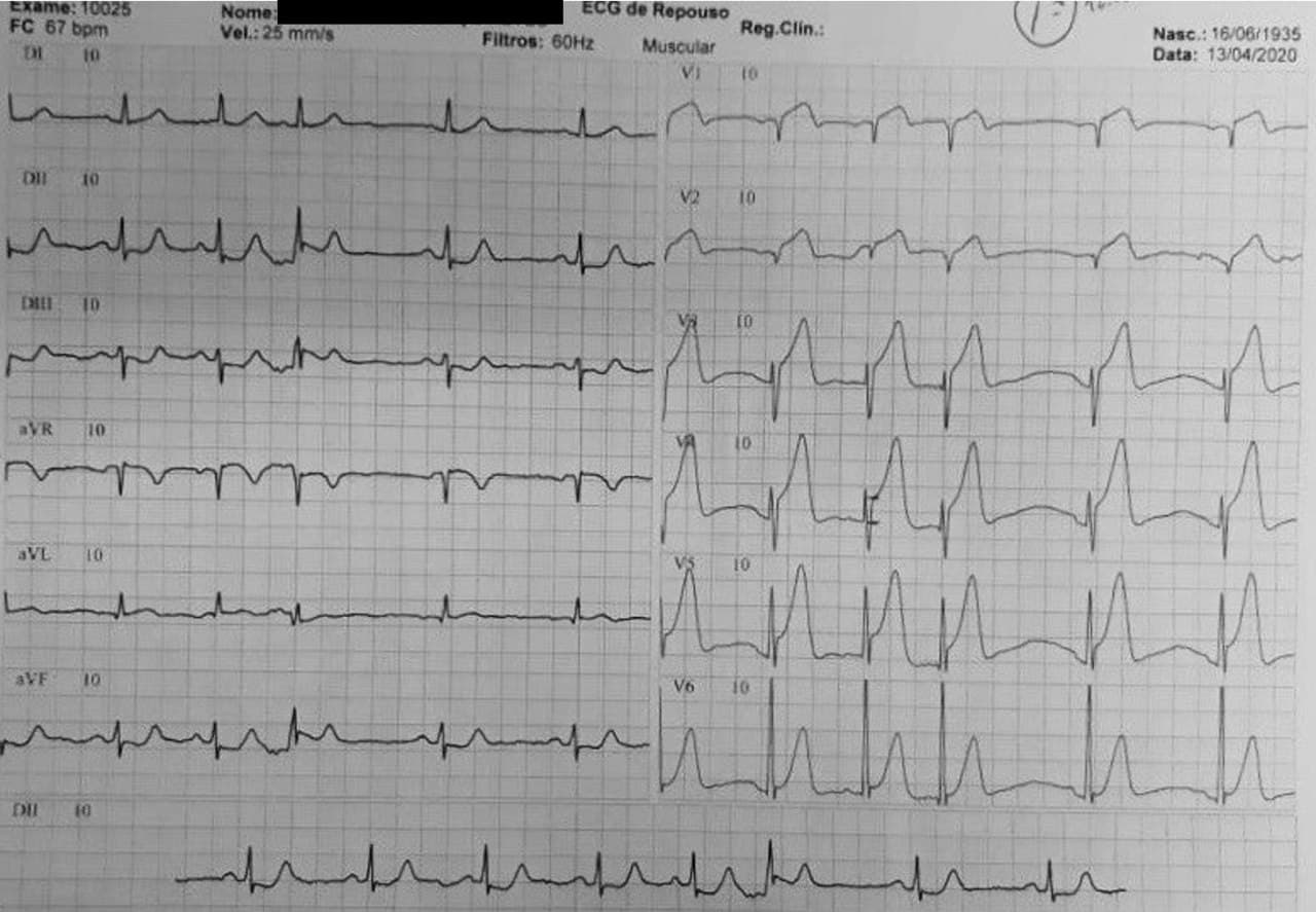Hombre de 85 años que presenta episodio de ángor prolongado por SCA que es tratado con tenecteplase, mostrando signos de reperfusión en el ECG, amén de la patente de infarto de cara anterior