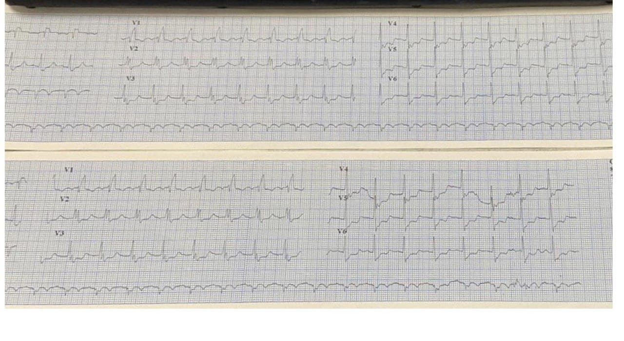 ECG perteneciente a un paciente de quién se ignoran datos clínicos, excepto estar afectado por COVID 19, en ventilación mecánica, con troponina + que evoluciona al óbito