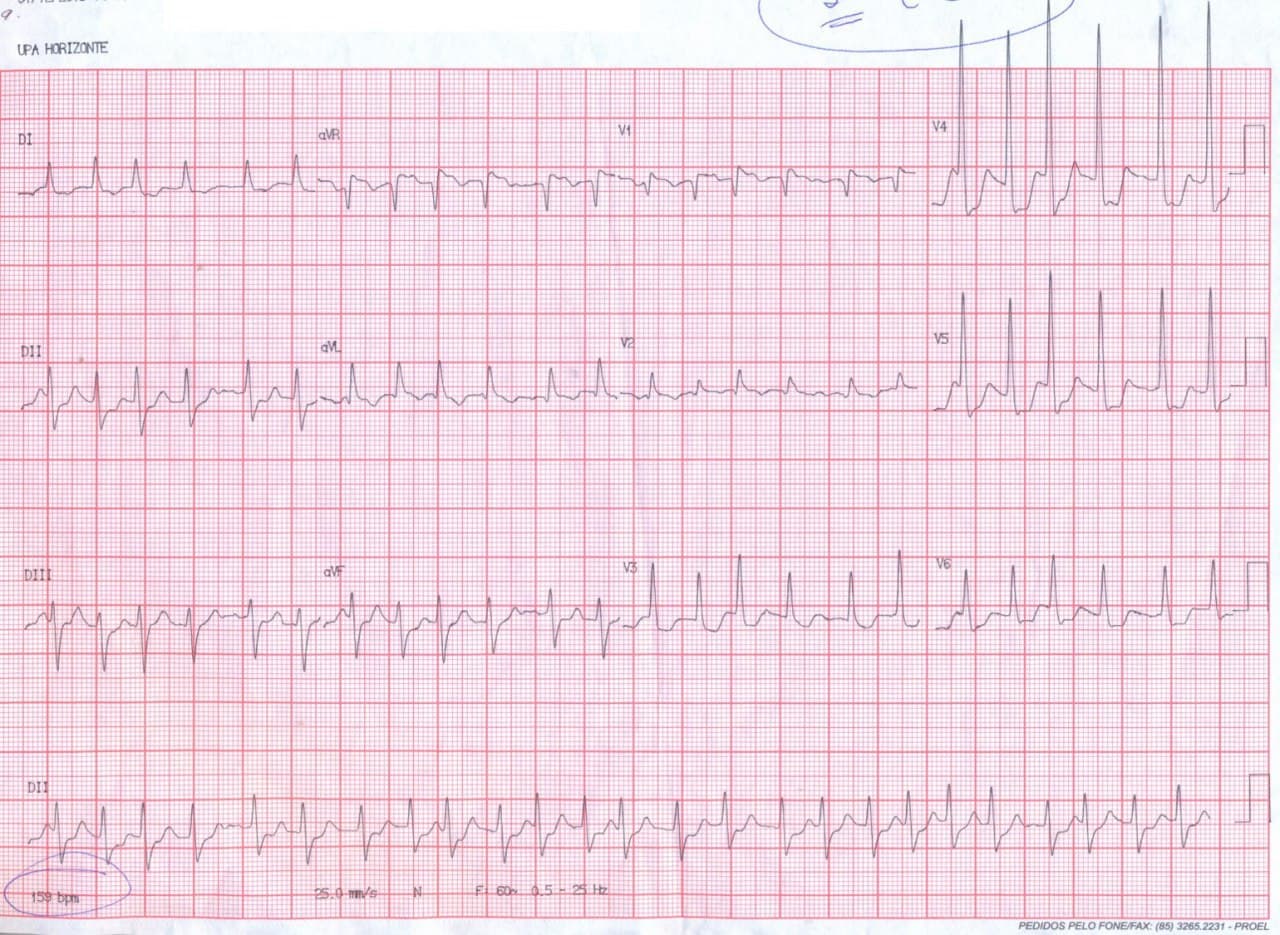 Hombre de 63 años con ángor desde hace dos meses que se hizo progresivo en los últimos días que presenta FAARV por severa enfermedad coronaria difusa con compromiso de TCI
