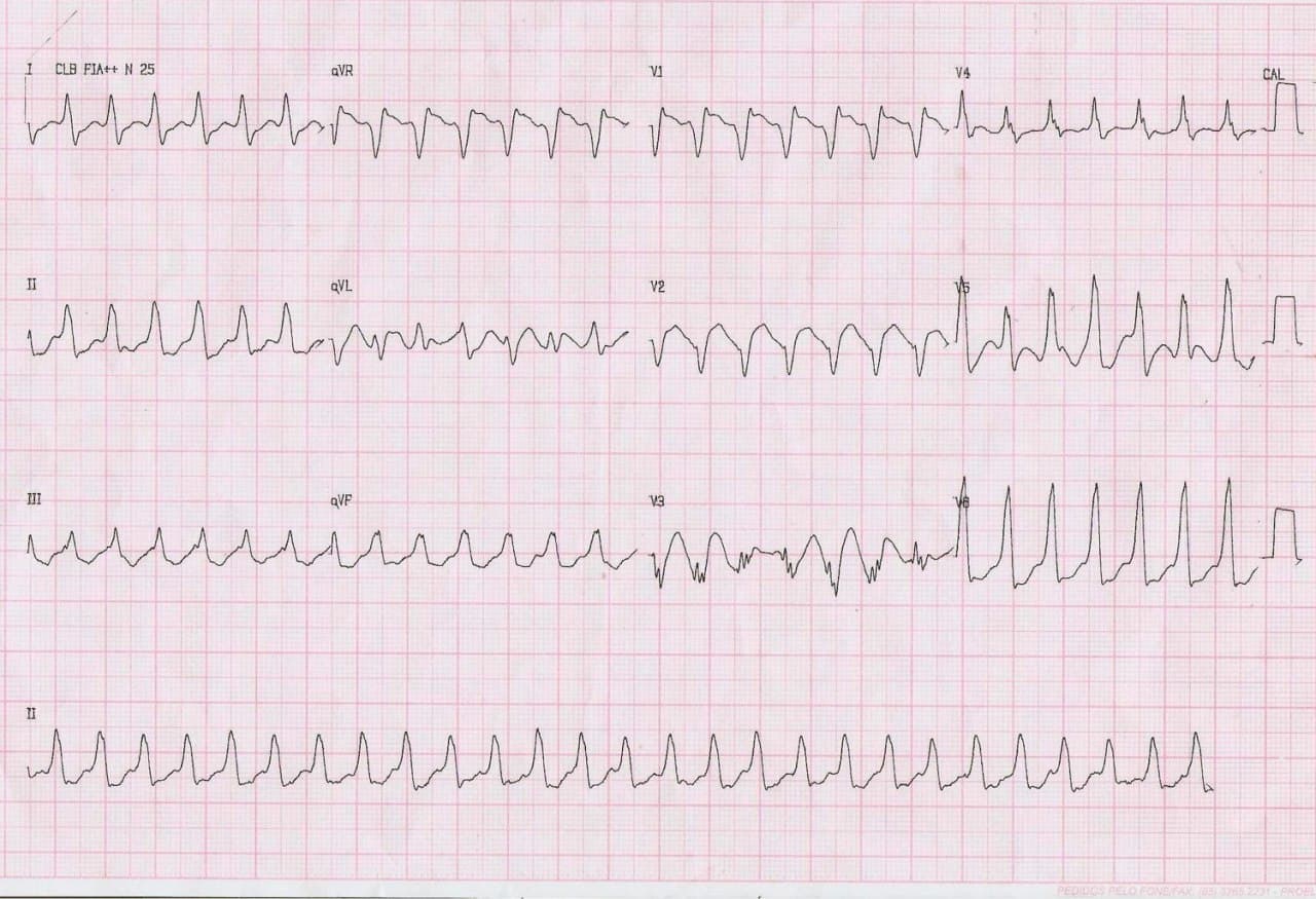 Hombre de 83 años con MP implantado por antecedente de BAVC que consulta por palpitaciones y síncope que presenta TV atribuible a intoxicación digitálica que motiva CVE, interrupción de digoxina y tratamiento con Mg