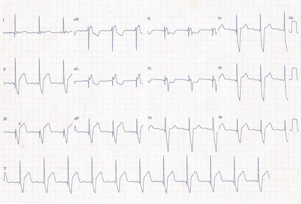 Paciente con MP implantado previamente que consulta por episodio de ángor cuyo ECG muestra signo de Sgarbosa + en V2 por compromiso de arteria Cx