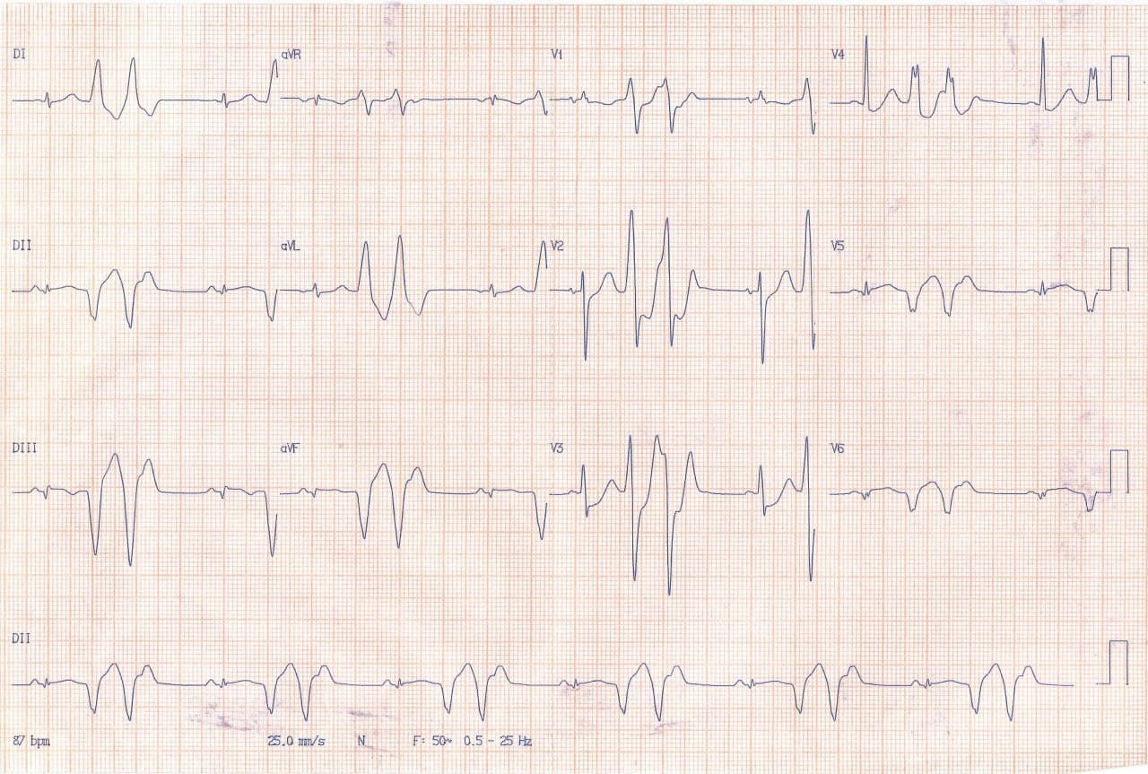 Paciente de 56 años con síncope precedido por palpitaciones por presencia de TV originada en escara  ínferolateral
