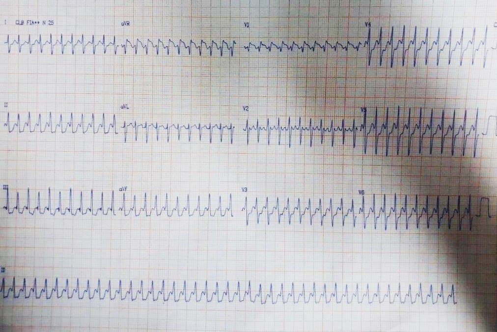 Paciente de 48 años cuya esposa refiere ser portador de FA crónica que presenta intensas palpitaciones por aleteo auricular 1:1 que pasa a ser 2:1 con inyección de adenosina