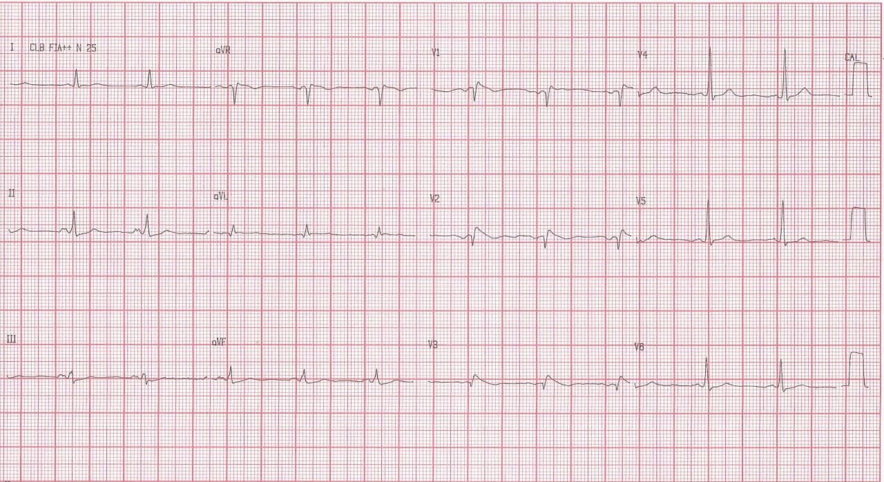 Paciente masculino de 75 años hipertenso y diabético que consulta por epigastralgia debida a gastritis comprobada endoscópicamente que es erróneamente interpretada como debida a infarto de miocardio en portador de patrón Brugada tipo I con troponina y CCG normales