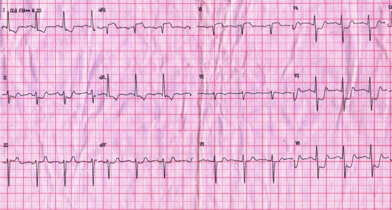 Hombre de 53 años, obeso e hipertenso que presenta episodio de ángor típico y disnea por compromiso de TCI