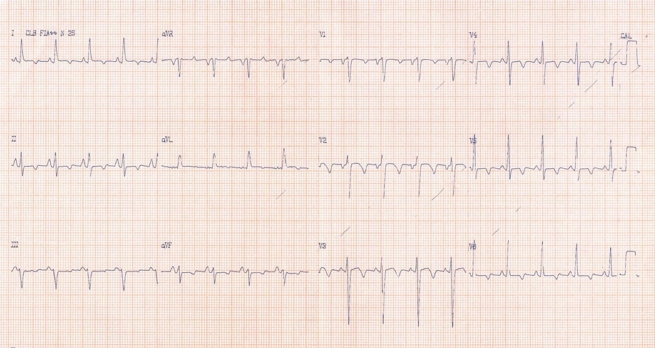 Mujer de 37 años que posteriormente a cursar con un cuadro febril, con tos y disnea diagnosticado como «neumonía» desarrolla insuficiencia cardíaca constatándose la presencia de una miocardiopatía dilatada con signos de miocarditis aguda