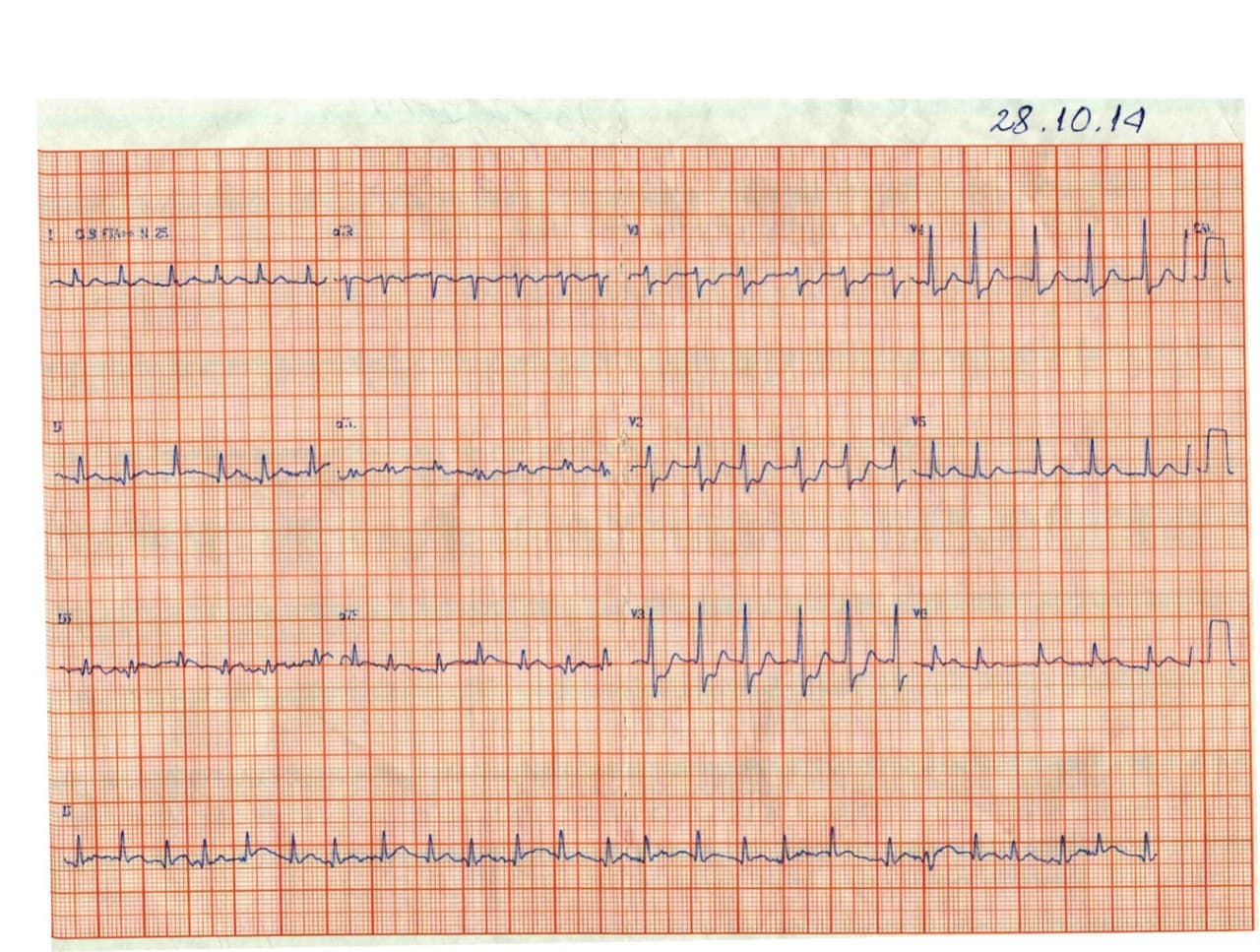 Hombre de 65 años que presenta episodio de ángor prolongado constatándose FA e isquemia subendocárdica anterior por enfermedad de tres vasos en quién se practica angiplastia con implante de stent exitosos en arteria Cx