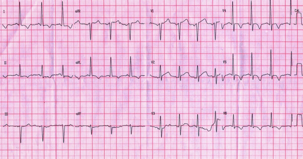 Paciente masculino hipertenso de 56 años con intenso dolor en cara anterior de tórax irradiado a dorso por cursar cuadro de disección aórtica