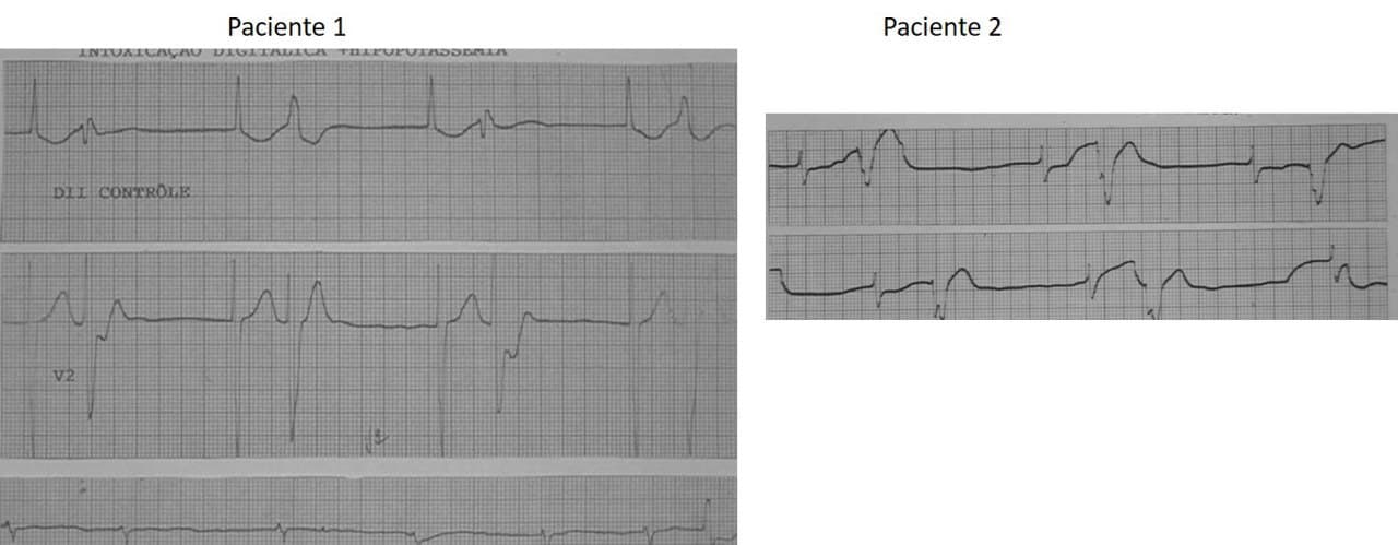 Sendos ECGs de dos pacientes con bigeminia escape captura por intoxicación digitálica y FA como ritmo de base