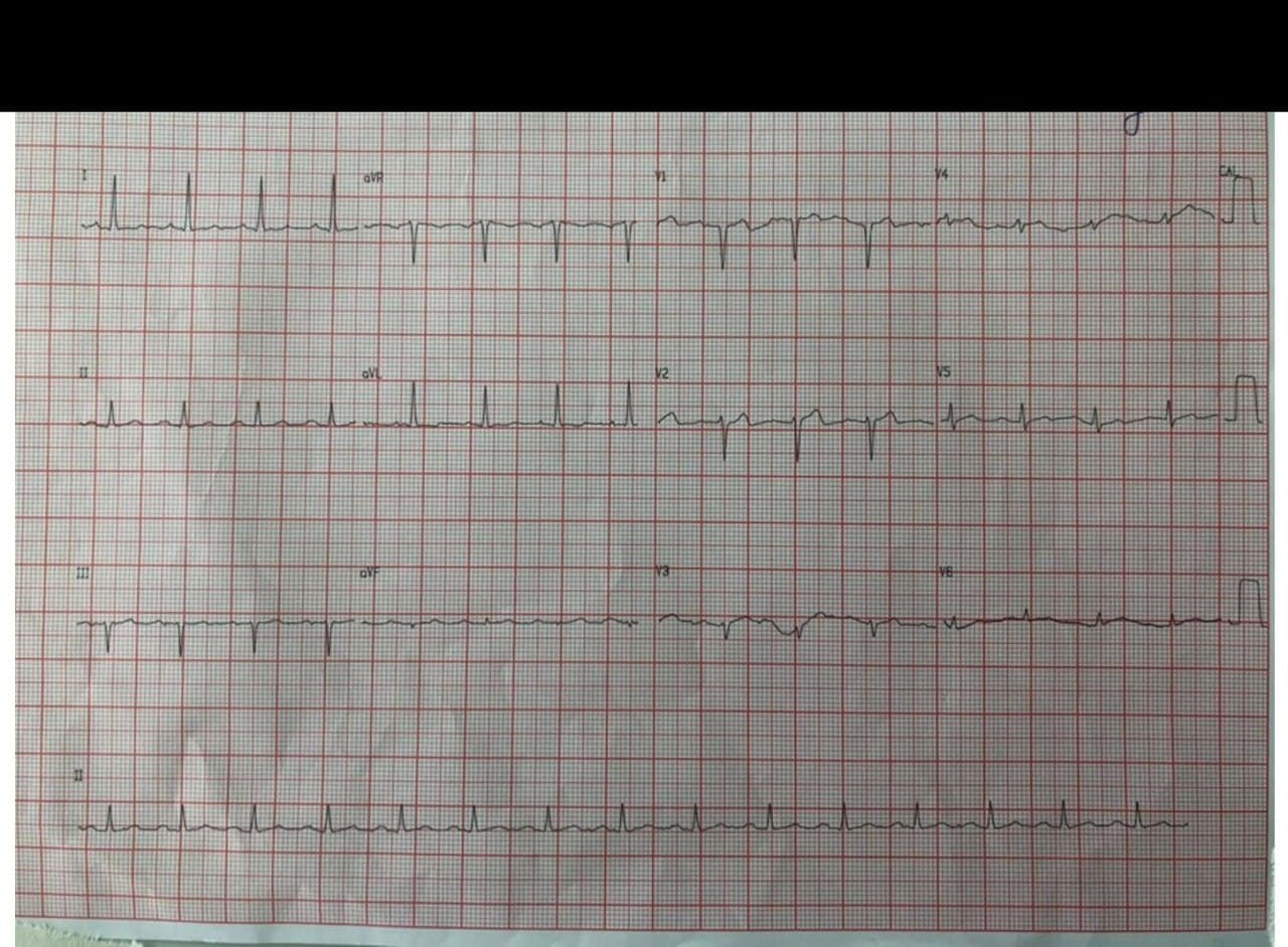 Paciente de 72 años HTA y DBT con disnea de reposo y paroxística nocturna que presenta síndrome de Wellens por suboclusión de DA (ECGs con y sin dolor)