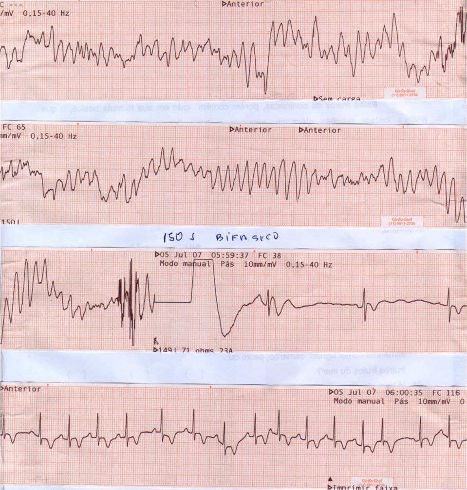 Mujer de 77 años, hipertensa previa que presenta episodio de ángor prolongado que evoluciona a FV que es revertida, constatándose CCG normal, por síndrome de TakoTsubo