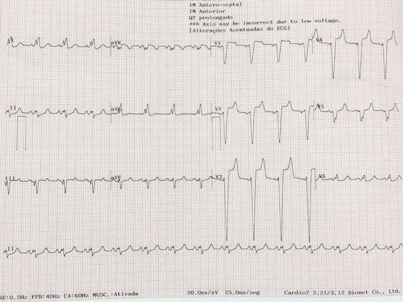 Médica de 53 años, que desarrolló shock y alteraciones pulmonares tipo SDRA en día 12 de covid