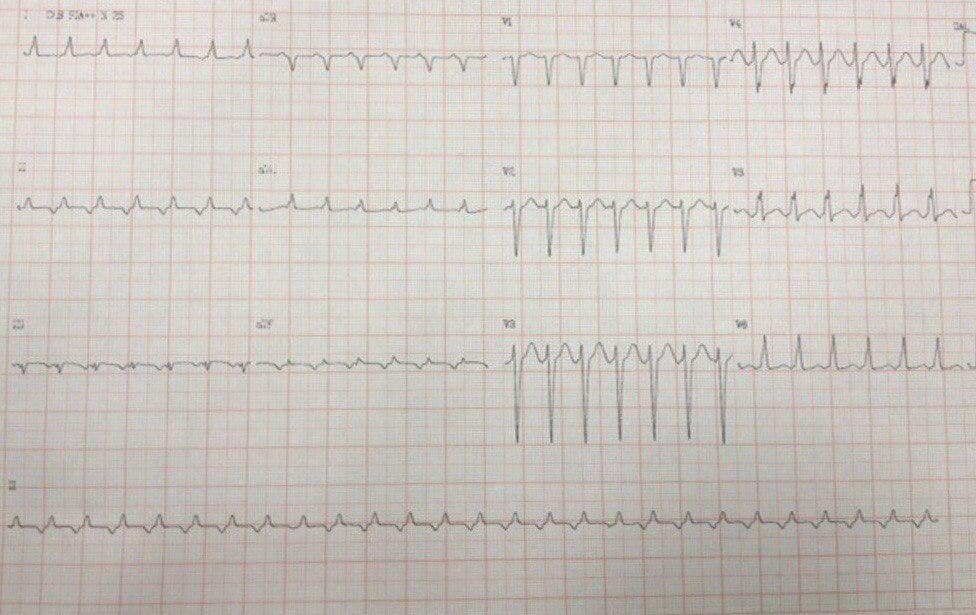 ECG de paciente que presenta taquicardia de QRS estrecho por taquicardia auricular con RP largo con buena respuesta a adenosina y reinicio de la arritmia al cesar efecto de la droga