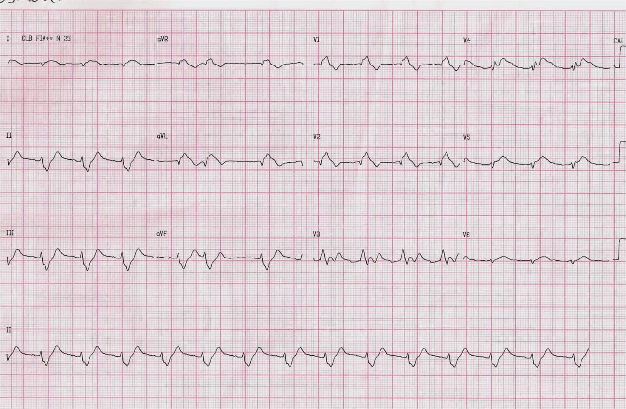 Hombre de 62 años HTA y DBT que presenta episodio de ángor prolongado acompañado de síntomas vagales por compromiso de TCI