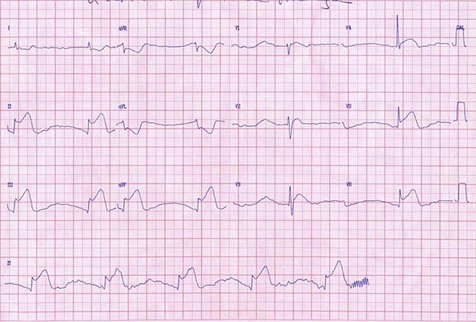 Paciente masculino de 71 años, hipertenso que presenta episodio de ángor prolongado por IAM inferior con compromiso de VD debido a oclusión 100% de CD