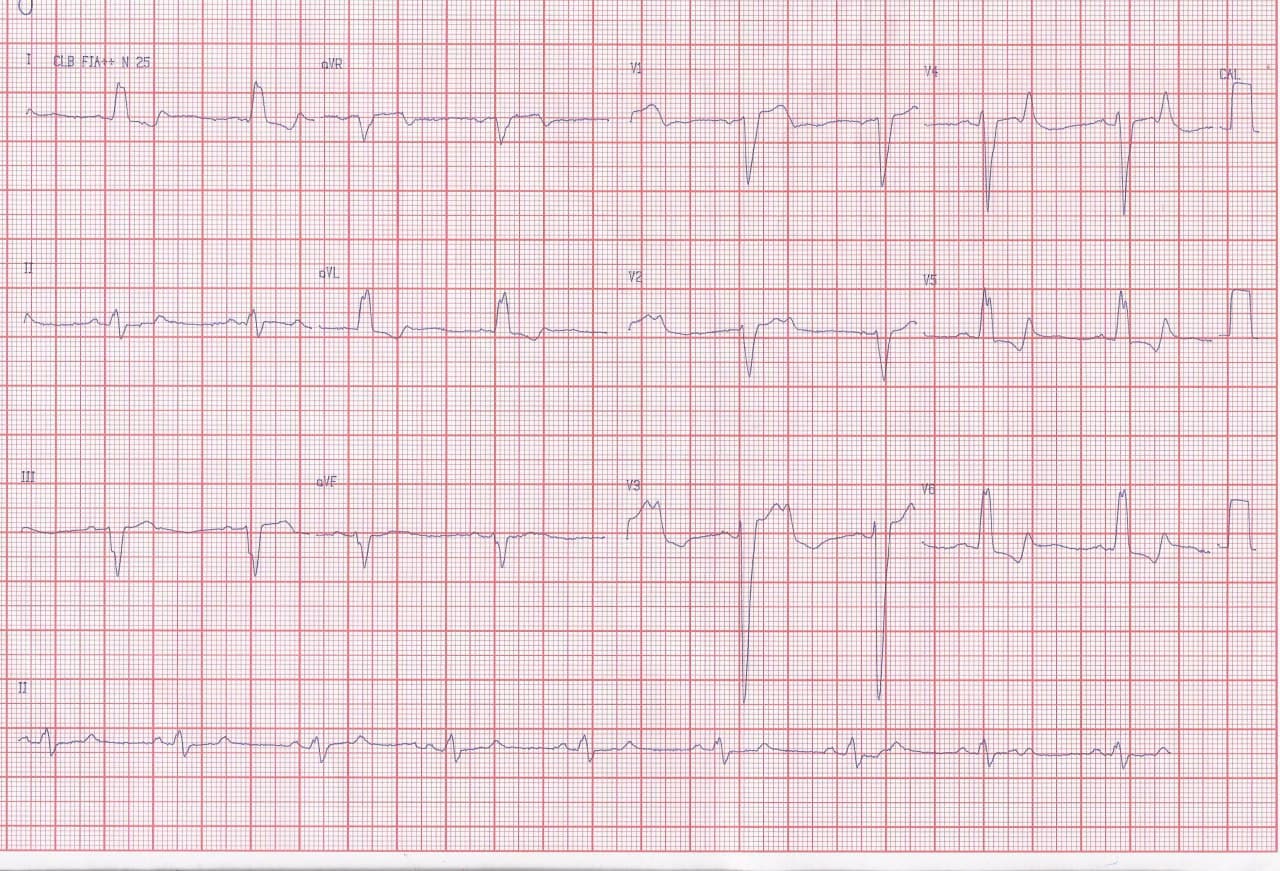 Hombre de 67 años con factores de riesgo que presenta disnea y ángor progresivos con BCRI + Bloqueo AV 2:1 por suboclusión de CD proximal