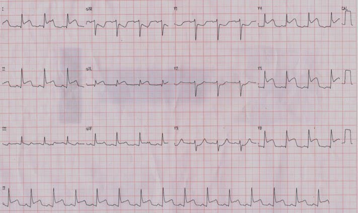 ECG de paciente con SCA por compromiso de arteria marginal de la Cx