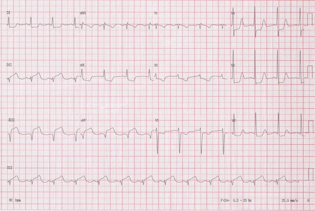 Hombre de 67 años con valvulopatía mitroaórtica reumáticas (insuficiencia) que cursa con SCA intraoperatorio de cirugía de reemplazo valvular por espasmo de CD