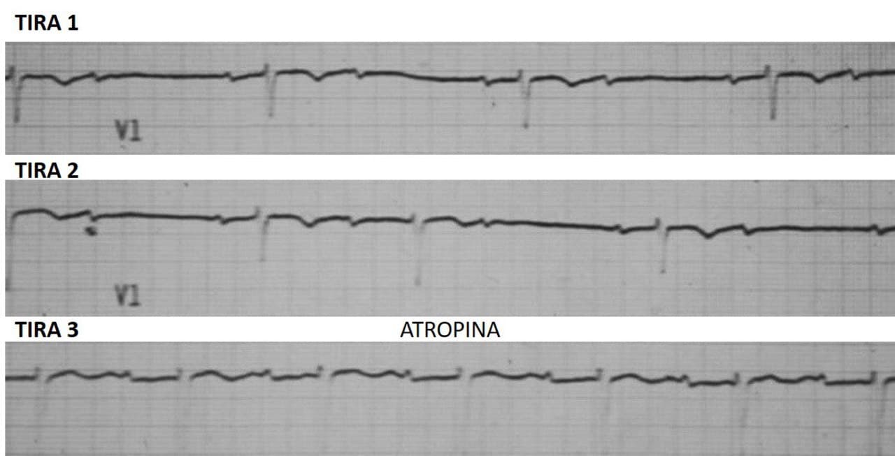 ECG que muestra BAV de alto grado que post atropina presenta mejora de la conducción AV