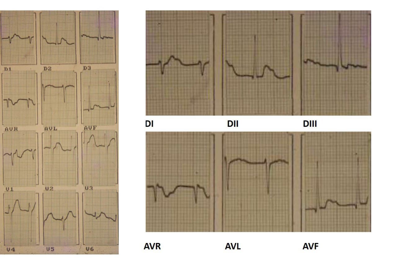 Paciente masculino de 42 años con fiebre y adinamia y soplo diastólico aórtico con vegetación y perforación valvular que a posteriori desarrolla BFPI por abceso del anillo mitroaórtico