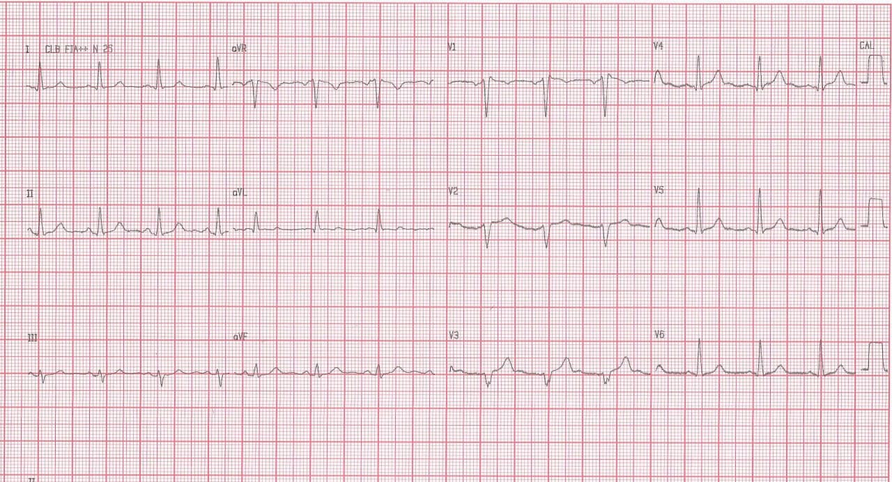 Hombre asintomático de 49 años con antecedentes familiares de MS y diagnóstico previo de bloqueo incompleto de rama derecha en quién se realiza test de ajmalina que desenmascara síndrome de Brugada