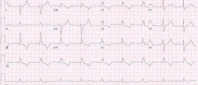 Hombre de 39 años oriundo de Canadá que presenta episodios sincopales cuyo ECG muestra BAVC con complejos anchos de BCRD + BFPI con serología reactiva para enfermedad de Lyme que es tratada con buena evolución electrocardiográfica
