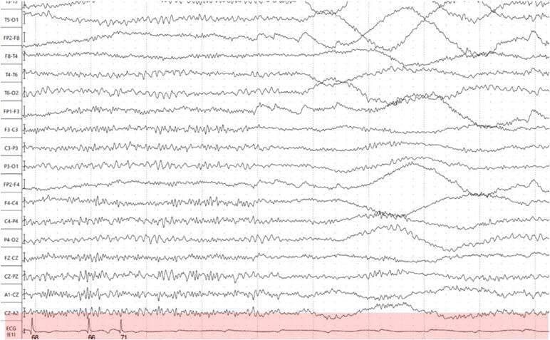 Paciente masculino de 62 años que presenta crisis convulsivas reiteradas tratado sin éxito con anticonvulsivos y que en los trazados EEG/ECG (tira inferior) muestra BAVC en coincidencia con la convulsión