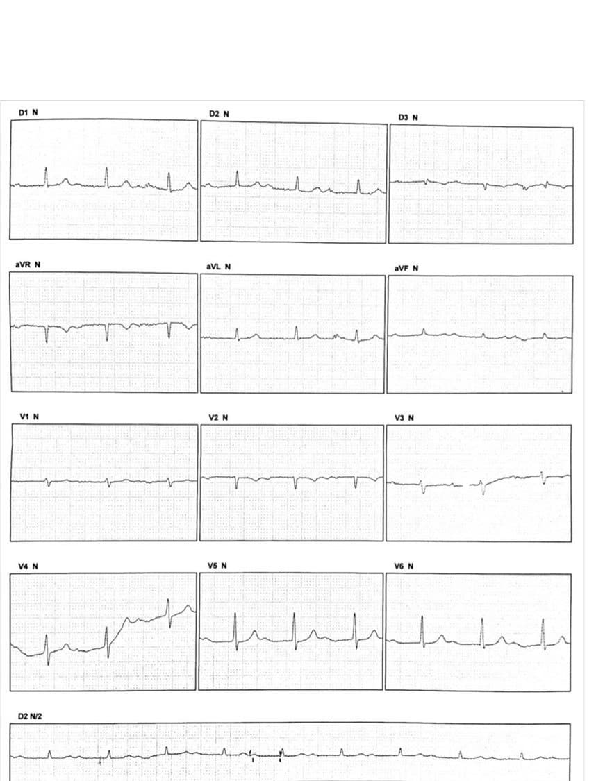Trazado de paciente de 64 años asintomático que presenta PRs variables de latido a latido por presencia de doble vía nodal