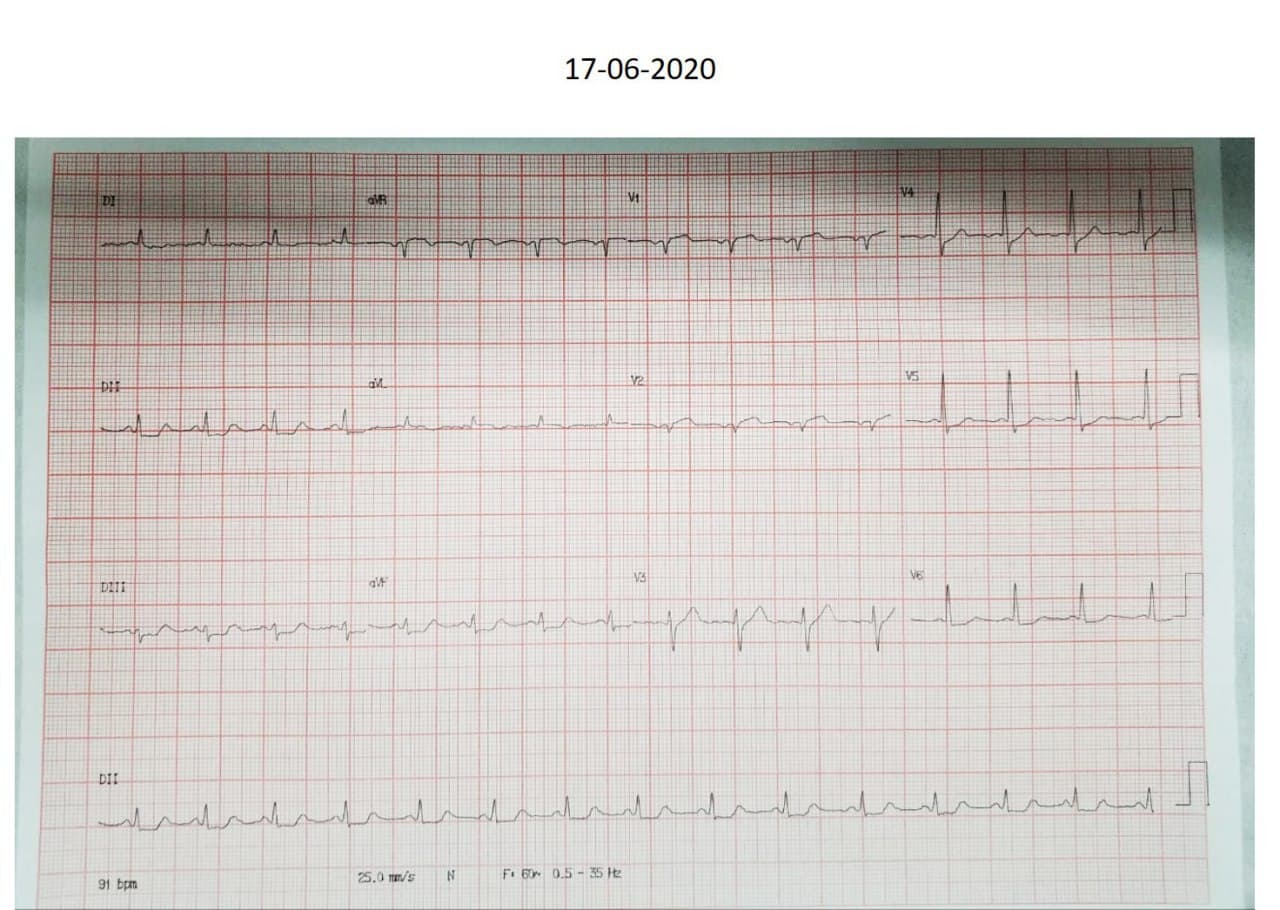 Mujer de 65 años hpertensa que presenta episodio de ángor intenso y prolongado por lesión de DA después de rama septal