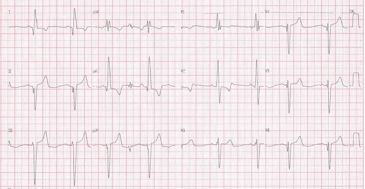 Mujer de 45 años con dolor precordial atípico y disnea que presenta HVI concéntrica severa y fQRS como expresión de fibrosis