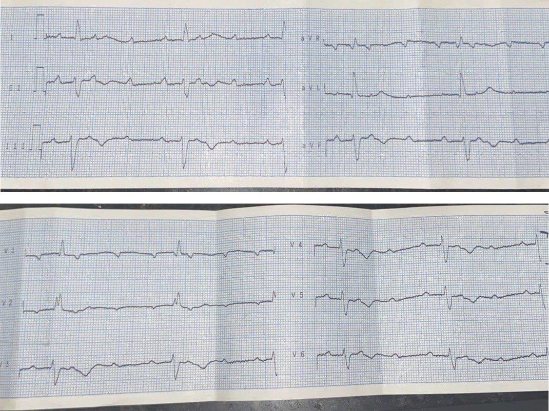 Mujer de 63 años, obesa, fumadora e hipertensa que cursa con fiebre, tos, diarrea y adinamia que presenta BAVC y en quién se constata COVID 19 +