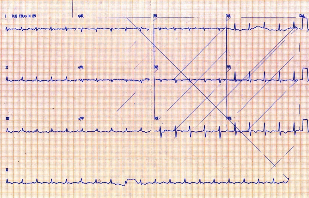 Mujer de 45 años con disnea y edemas de MMII que manifiesta antecedentes de TBC pulmonar en quién se constata una pericarditis constrictiva