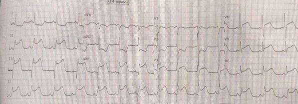 Mujer de 70 años cursando infección por COVID 19 con angor prolongado y disnea por compromiso de CD que se somete a angioplastia primaria con implante de stent  e interacción farmacológica con drogas antivirales