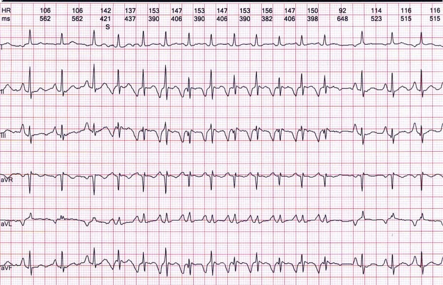 Mujer de 27 años con palpitaciones crónicas desde la adolescencia que presenta taquicardia auricular